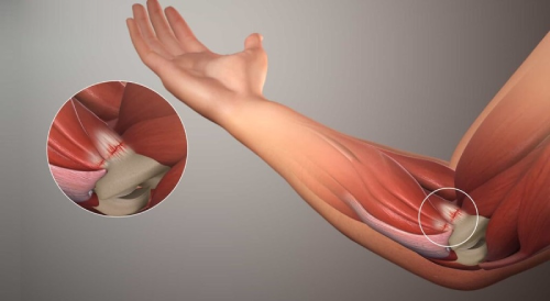 chấn thương dây chằng khuỷu tay